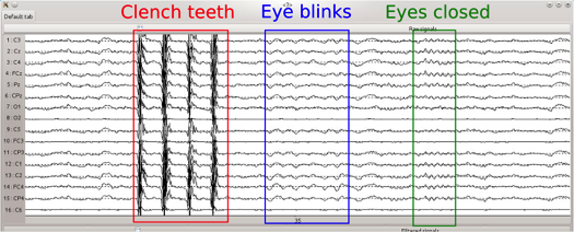 EEG artifacts